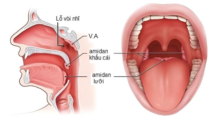 Viêm amidan ở trẻ em: nguyên nhân, triệu chứng và biện pháp điều trị