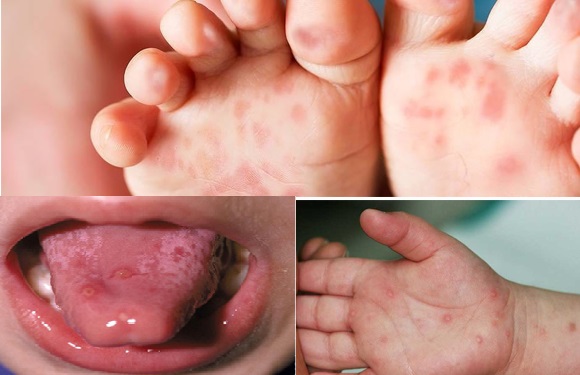 Những bệnh thường gặp ở trẻ nhỏ trong mùa nắng nóng