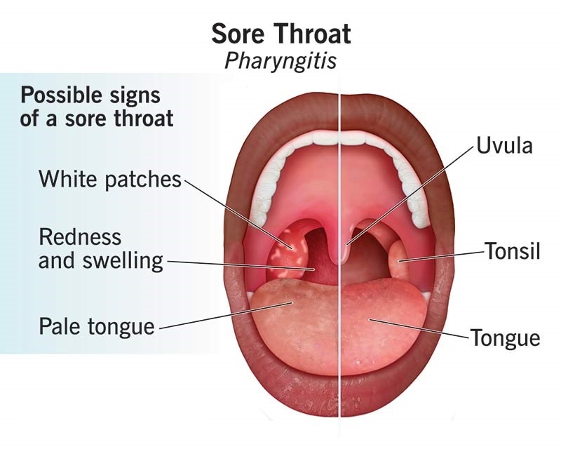 Điều trị bệnh viêm họng cấp ở trẻ em
